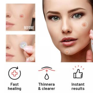 Before and after using Magical Patch acne patch